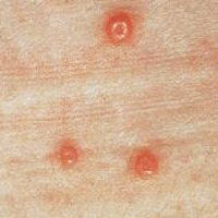 molluscum contagiosum on the penis Girls squatting pissing